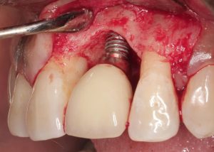 implant-dentar-bluem